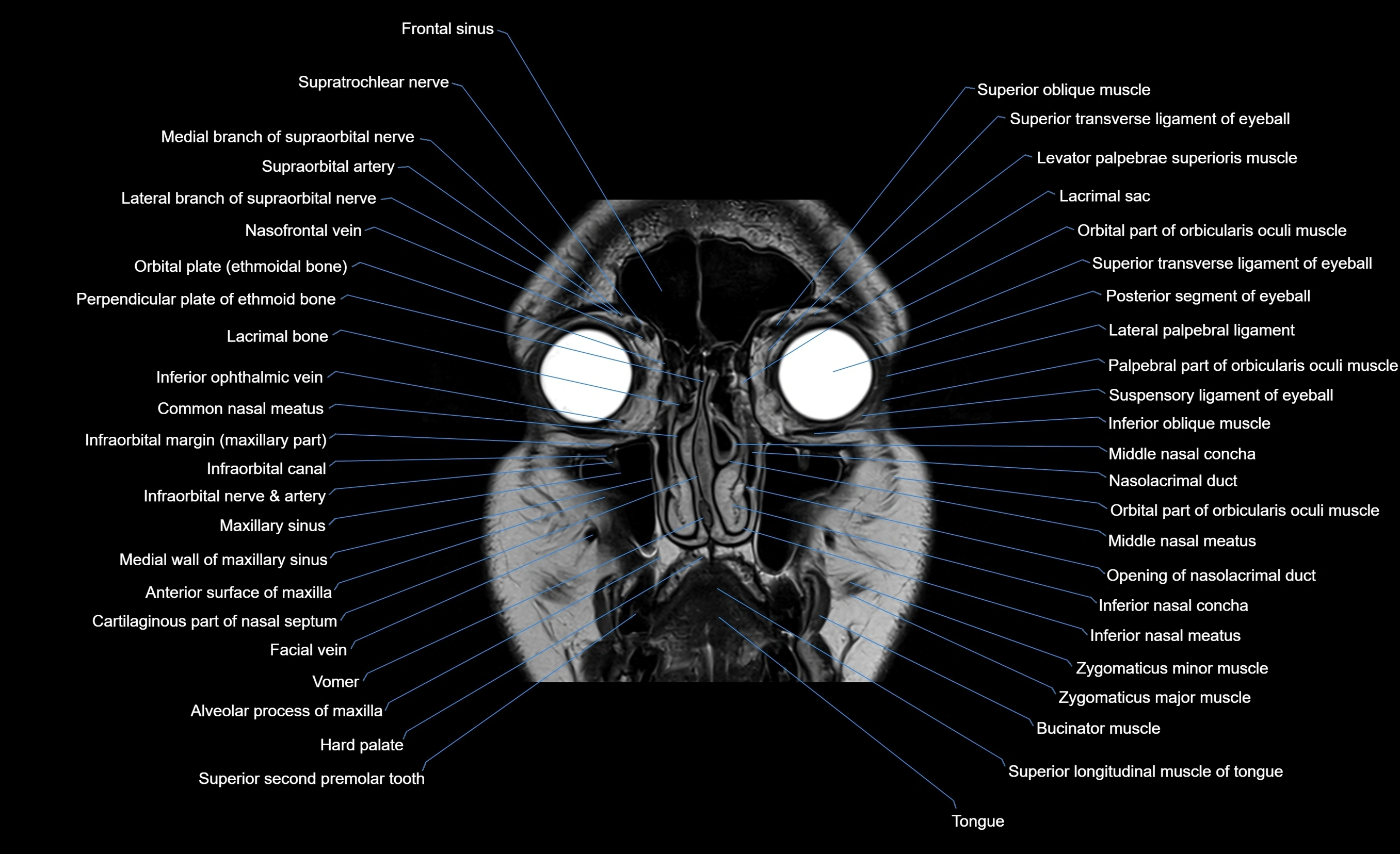 MRI face & paranasal sinuses(PNS) labelled  coronal  cross sectional anatomy 3T radiology  image-img-00001-00016.webp